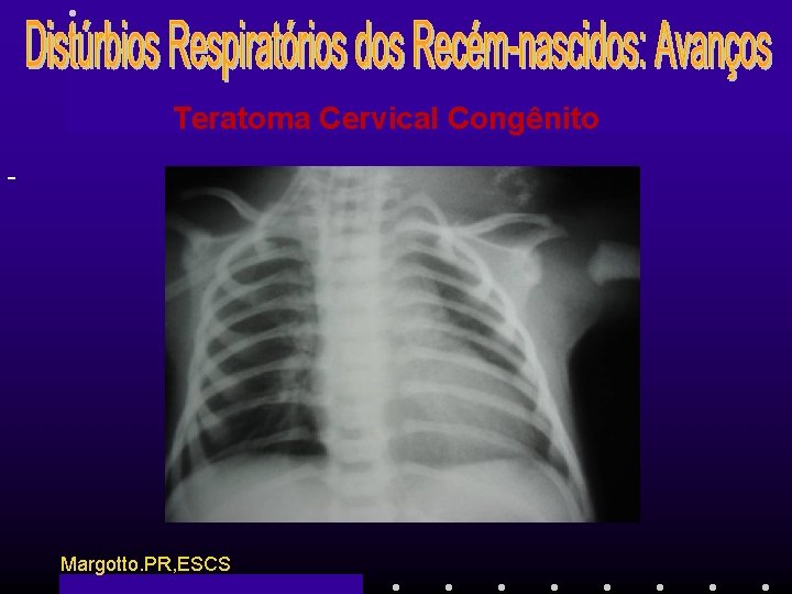 Teratoma Cervical Congênito - Margotto. PR, ESCS 