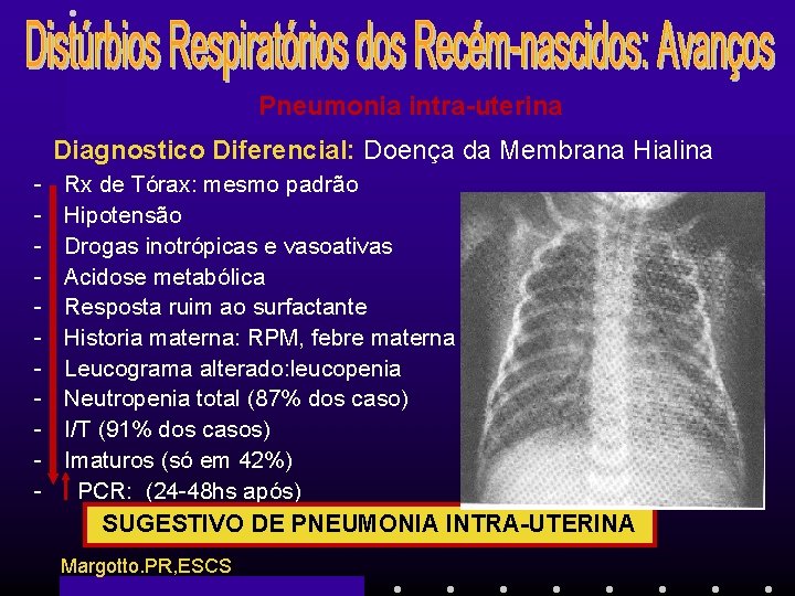 Pneumonia intra-uterina Diagnostico Diferencial: Doença da Membrana Hialina - Rx de Tórax: mesmo padrão