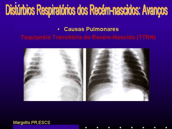  • Causas Pulmonares Taquipnéia Transitória do Recém-Nascido (TTRN) Margotto. PR, ESCS 