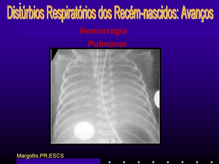 Hemorragia Pulmonar Margotto. PR, ESCS 