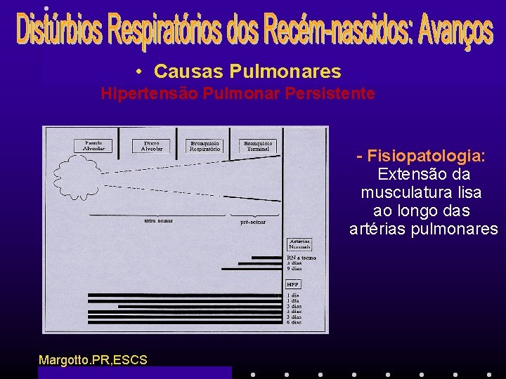 • Causas Pulmonares Hipertensão Pulmonar Persistente - Fisiopatologia: Extensão da musculatura lisa ao