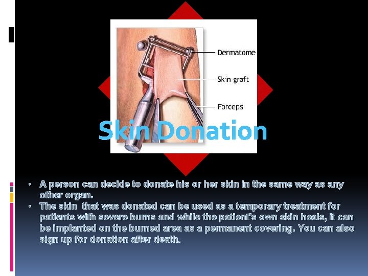 Skin Donation • A person can decide to donate his or her skin in