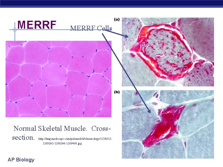 MERRF Cells Normal Skeletal Muscle. Crosssection. http: //img. medscape. com/pi/emed/ckb/neurology/11348151189245 -1189246 -1189490. jpg AP