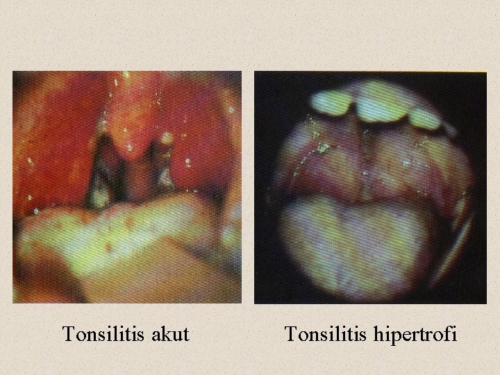 Tonsilitis akut Tonsilitis hipertrofi 