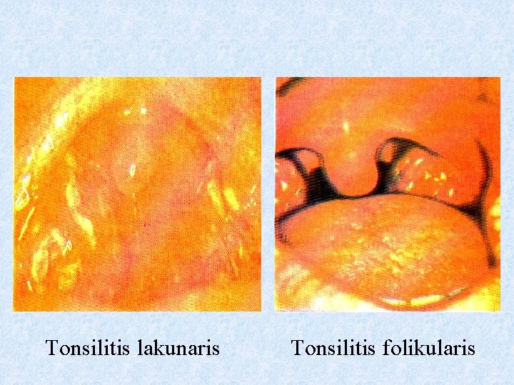 Tonsilitis lakunaris Tonsilitis folikularis 