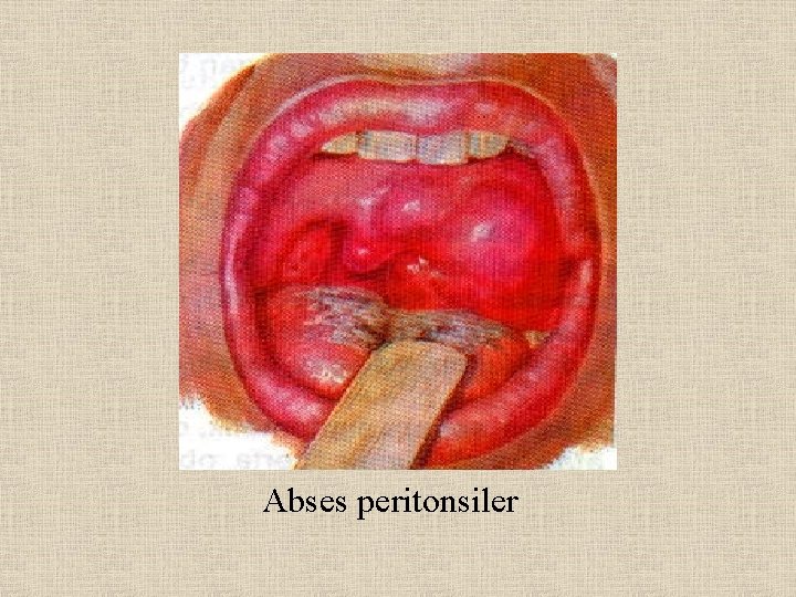 Abses peritonsiler 