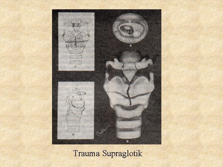 Trauma Supraglotik 