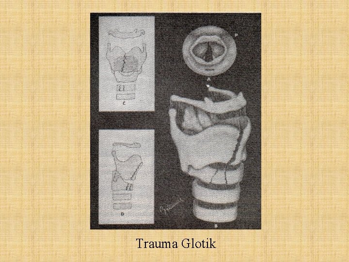Trauma Glotik 