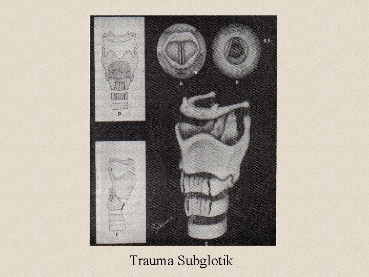Trauma Subglotik 