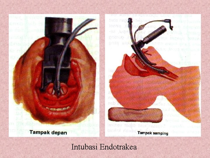 Intubasi Endotrakea 