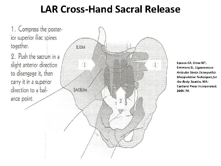 LAR Cross-Hand Sacral Release Speece CA, Crow WT, Simmons SL. Ligamentous Articular Strain Osteopathic