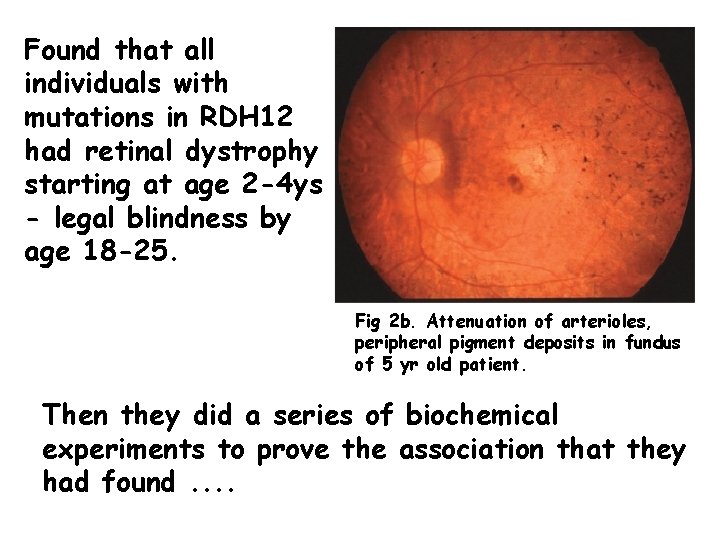 Found that all individuals with mutations in RDH 12 had retinal dystrophy starting at