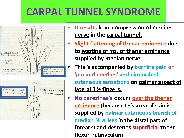 CARPAL TUNNEL SYNDROME • It results from compression of median nerve in the carpal