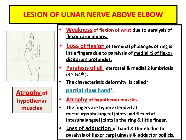 LESION OF ULNAR NERVE ABOVE ELBOW • Weakness of flexion of wrist due to