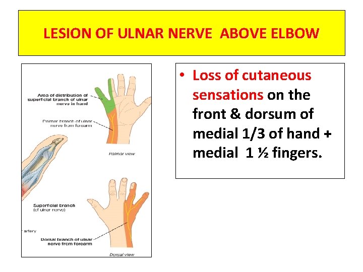 LESION OF ULNAR NERVE ABOVE ELBOW • Loss of cutaneous sensations on the front