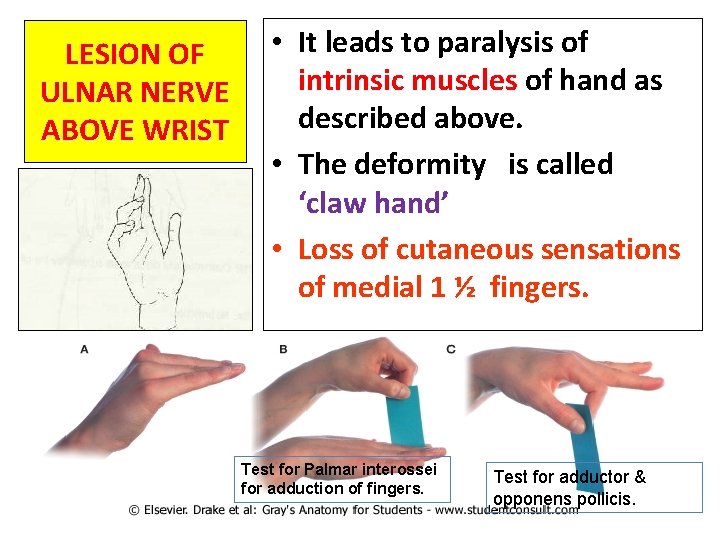 LESION OF ULNAR NERVE ABOVE WRIST • It leads to paralysis of intrinsic muscles