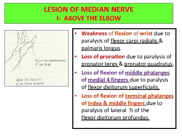 LESION OF MEDIAN NERVE I- ABOVE THE ELBOW • Weakness of flexion of wrist