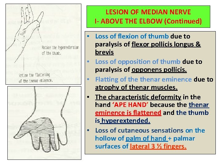 LESION OF MEDIAN NERVE I- ABOVE THE ELBOW (Continued) • Loss of flexion of