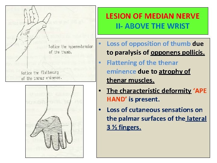 LESION OF MEDIAN NERVE II- ABOVE THE WRIST • Loss of opposition of thumb