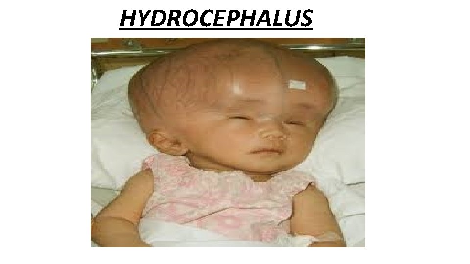 HYDROCEPHALUS 