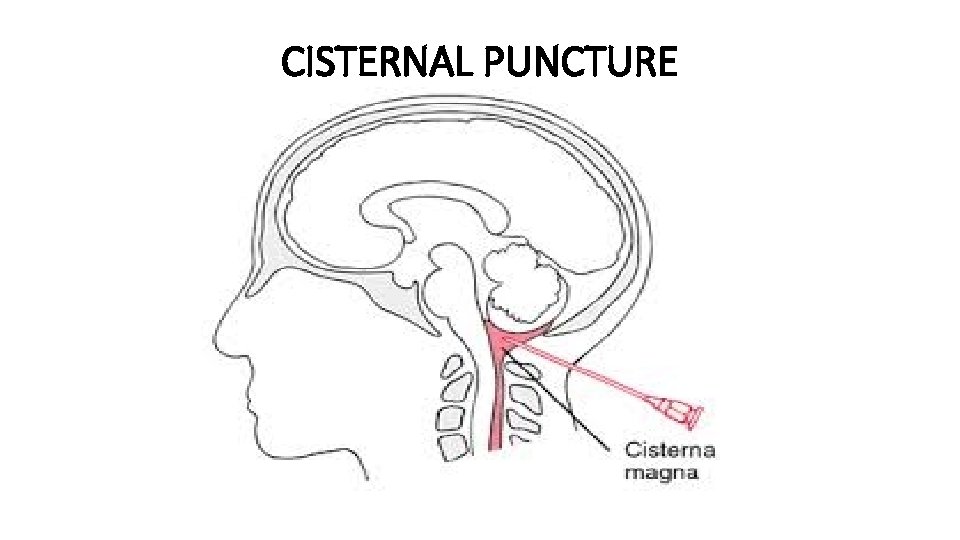 CISTERNAL PUNCTURE 
