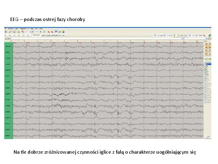 EEG – podczas ostrej fazy choroby Na tle dobrze zróżnicowanej czynności iglice z falą