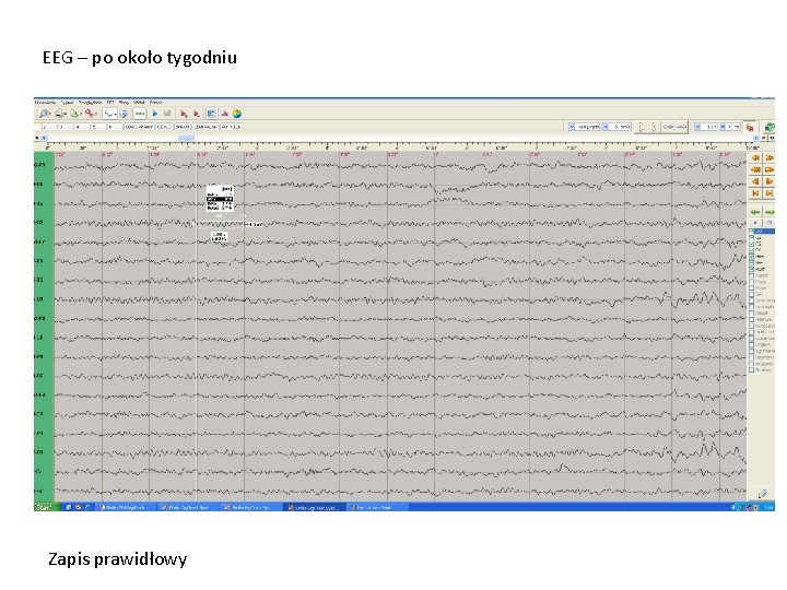 EEG – po około tygodniu Zapis prawidłowy 