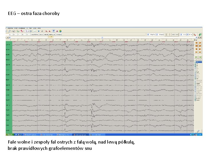 EEG – ostra faza choroby Fale wolne i zespoły fal ostrych z falą wolą,