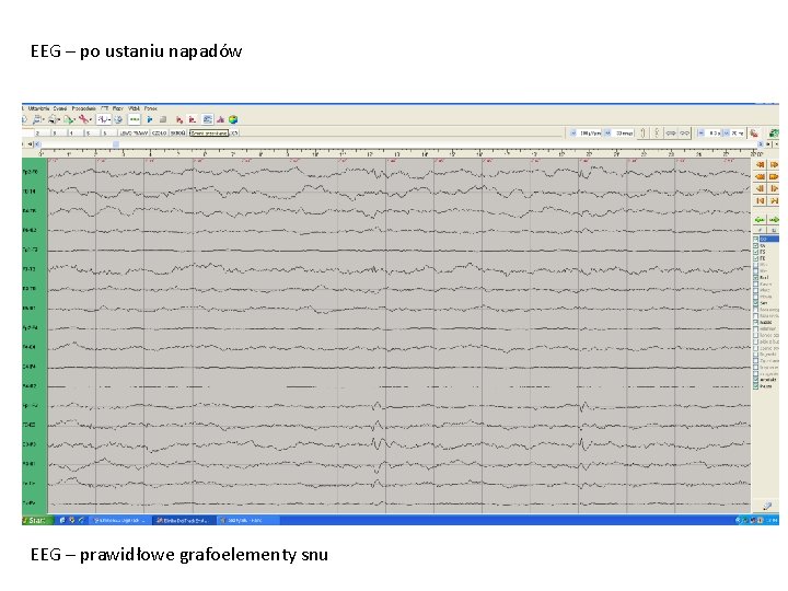 EEG – po ustaniu napadów EEG – prawidłowe grafoelementy snu 