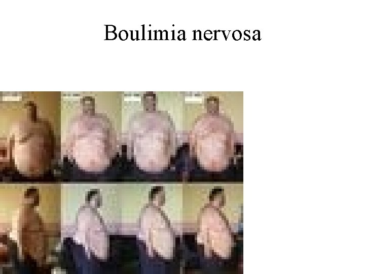 Boulimia nervosa 