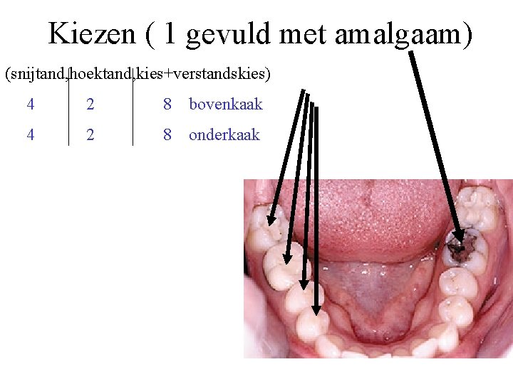Kiezen ( 1 gevuld met amalgaam) (snijtand, hoektand, kies+verstandskies) 4 2 8 bovenkaak 4
