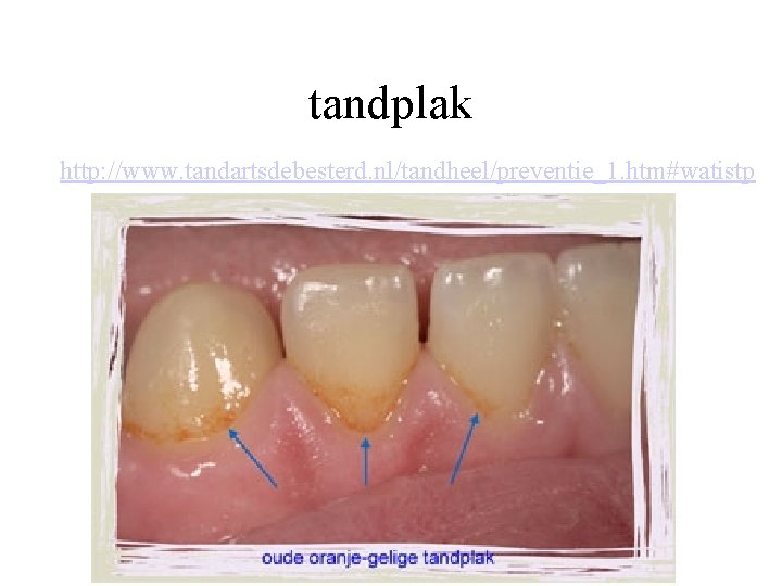 tandplak http: //www. tandartsdebesterd. nl/tandheel/preventie_1. htm#watistp 