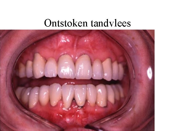 Ontstoken tandvlees 