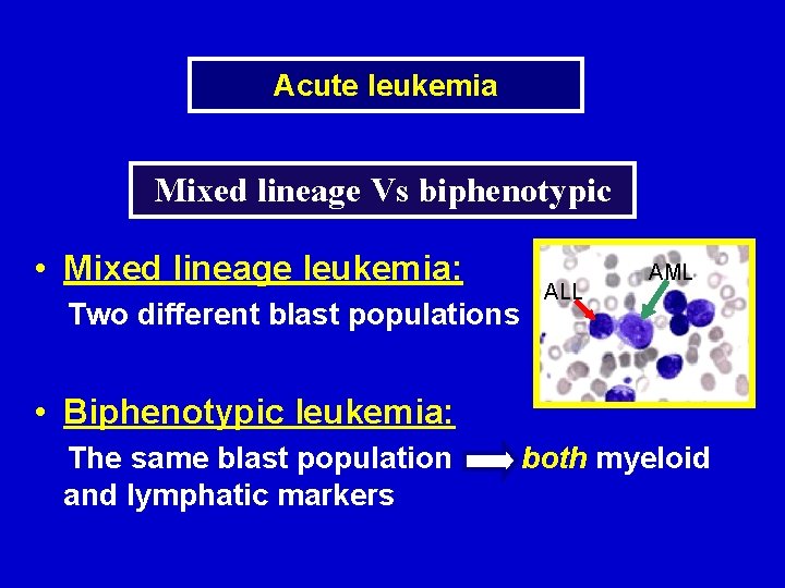 Acute leukemia Mixed lineage Vs biphenotypic • Mixed lineage leukemia: Two different blast populations