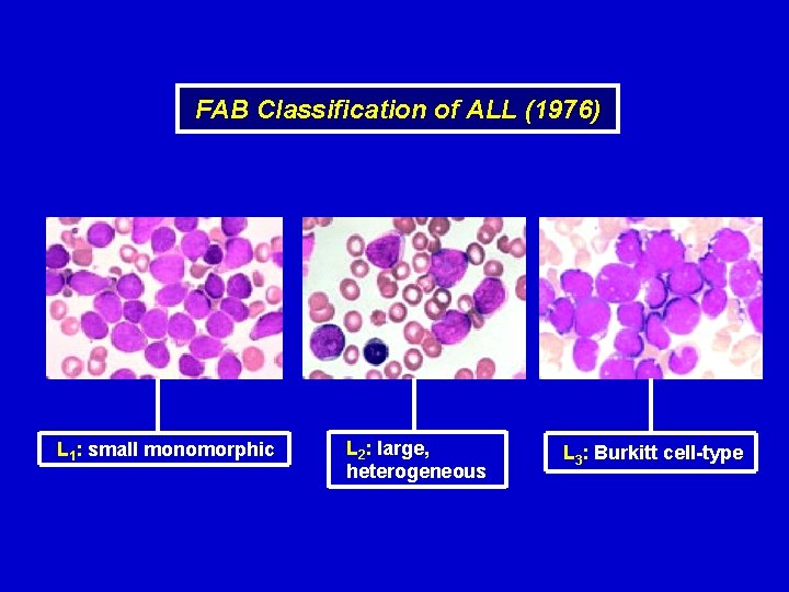 FAB Classification of ALL (1976) L 1: small monomorphic L 2: large, heterogeneous L