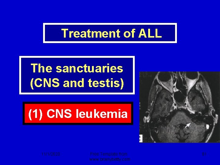  Treatment of ALL The sanctuaries (CNS and testis) (1) CNS leukemia 11/1/2020 Free