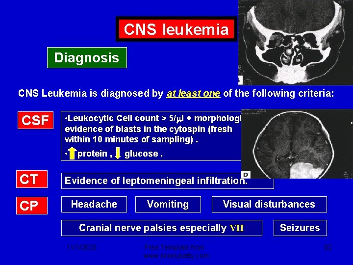 CNS leukemia Diagnosis CNS Leukemia is diagnosed by at least one of the following