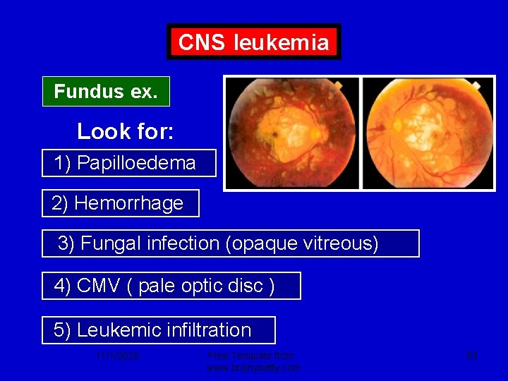 CNS leukemia Fundus ex. Look for: 1) Papilloedema 2) Hemorrhage 3) Fungal infection (opaque