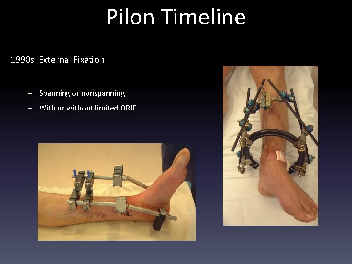 Pilon Timeline 1990 s External Fixation – Spanning or nonspanning – With or without