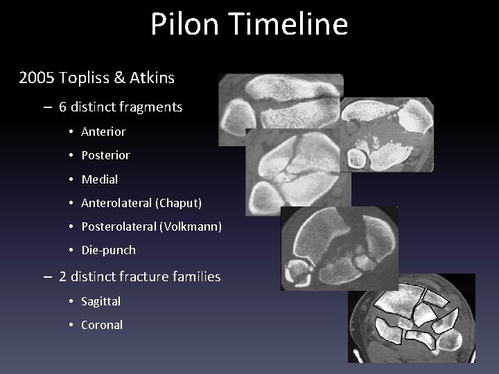 Pilon Timeline 2005 Topliss & Atkins – 6 distinct fragments • Anterior • Posterior