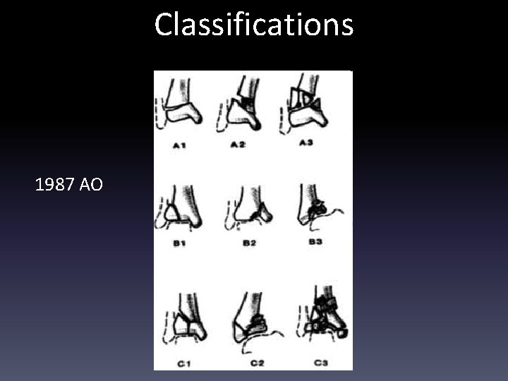 Classifications 1987 AO 
