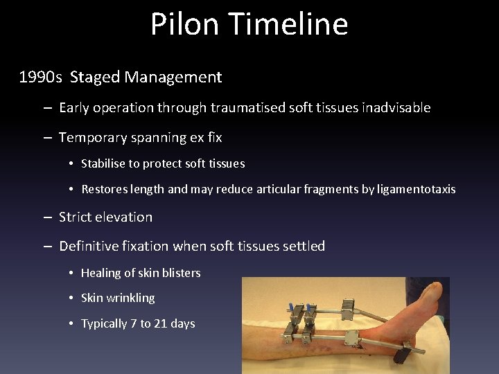 Pilon Timeline 1990 s Staged Management – Early operation through traumatised soft tissues inadvisable