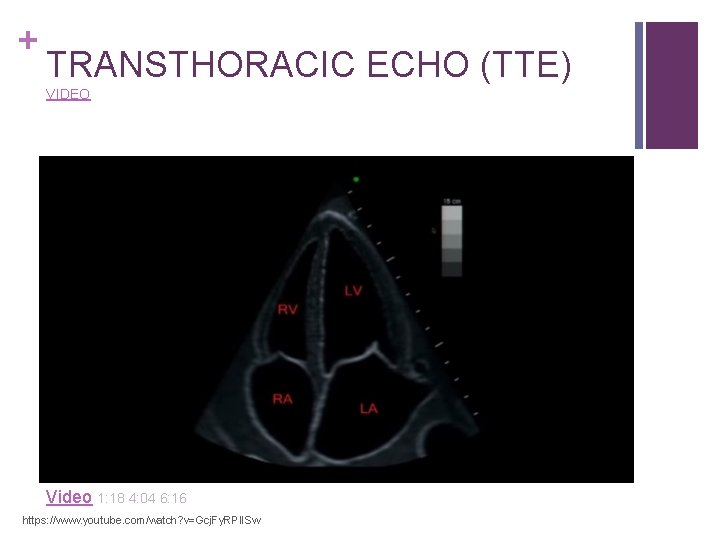 + TRANSTHORACIC ECHO (TTE) VIDEO Video 1: 18 4: 04 6: 16 https: //www.