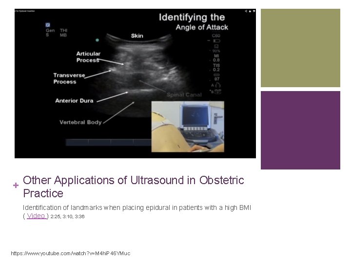 + Other Applications of Ultrasound in Obstetric Practice Identification of landmarks when placing epidural