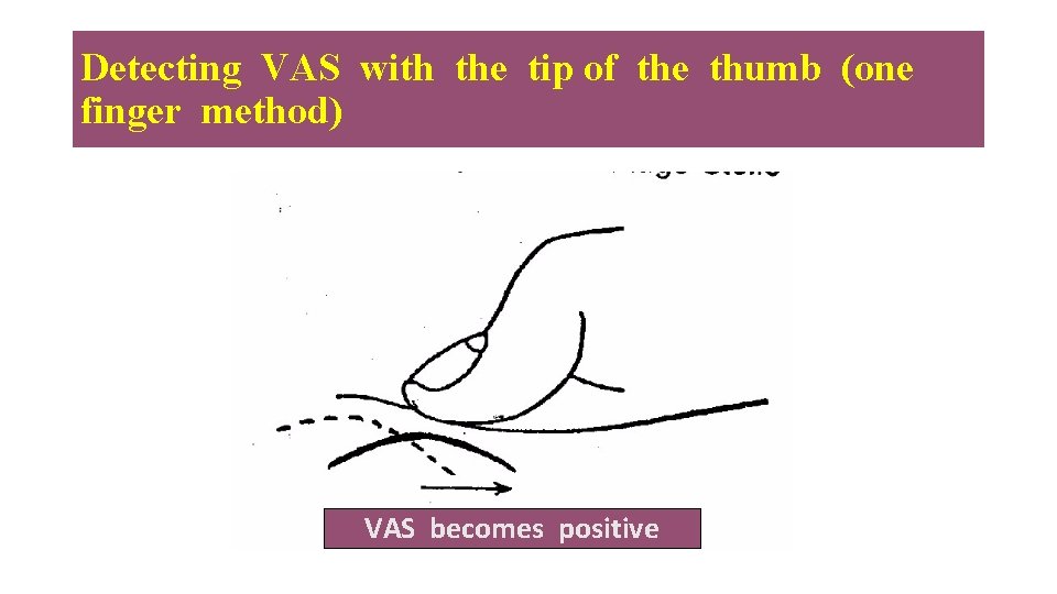 Detecting VAS with the tip of the thumb (one finger method) VAS becomes positive