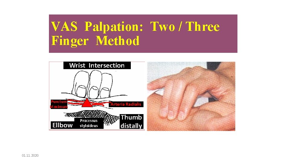 VAS Palpation: Two / Three Finger Method Wrist Intersection Punctum Maximum Ellbow 01. 11.