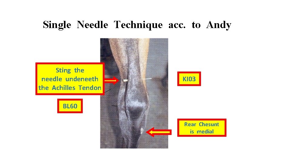 Single Needle Technique acc. to Andy Sting the needle undeneeth the Achilles Tendon KI