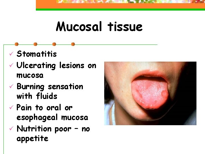 Mucosal tissue ü ü ü Stomatitis Ulcerating lesions on mucosa Burning sensation with fluids