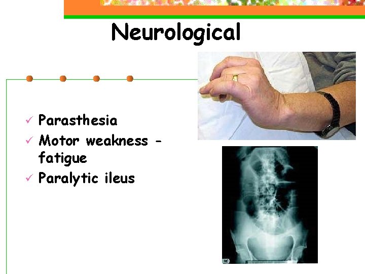 Neurological ü ü ü Parasthesia Motor weakness fatigue Paralytic ileus 