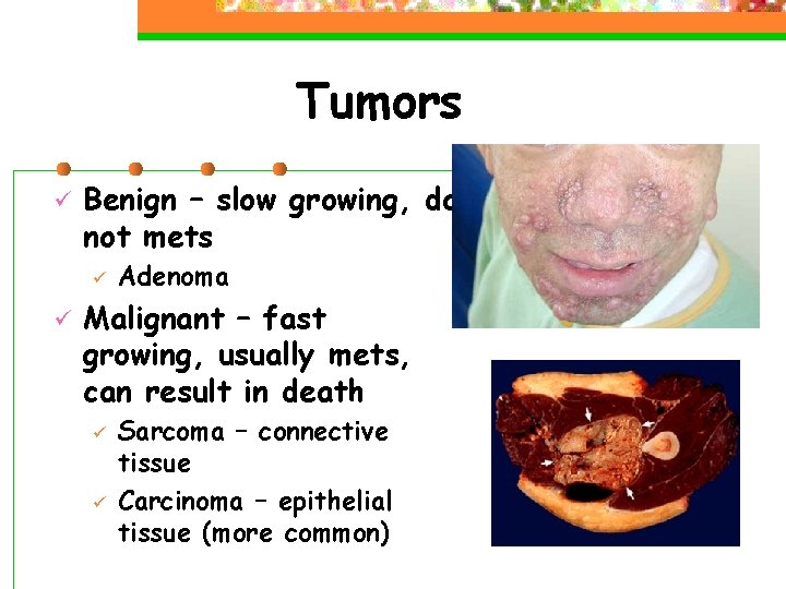 Tumors ü Benign – slow growing, do not mets ü ü Adenoma Malignant –